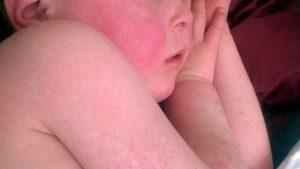 As scarlet fever cases rise, baffled researchers investigate 22