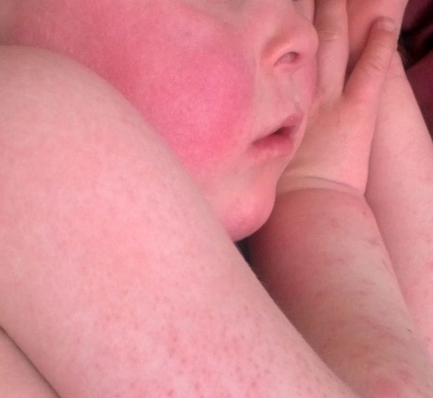 As scarlet fever cases rise, baffled researchers investigate