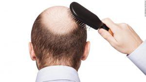 Balding, premature graying tied to higher heart disease risk 3