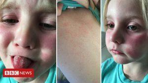 Schools warned over scarlet fever rise 68