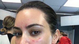 Kim Kardashian Shares Pic Of 'Extremely Bad' Psoriasis On Her Face 1