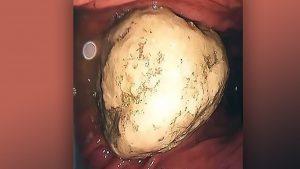 Woman develops 2-inch bezoar in stomach after diet of crab meat and persimmons 4